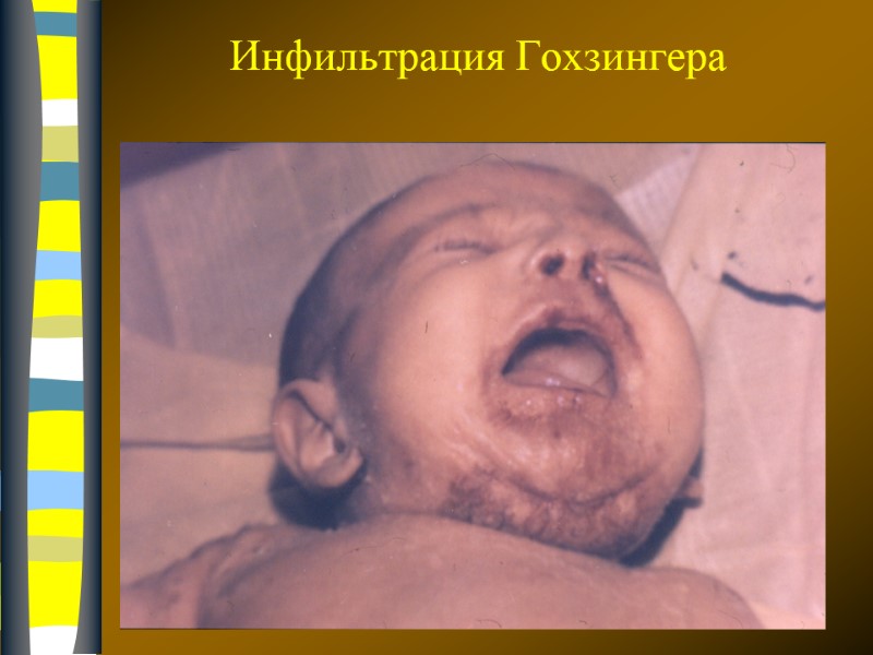 09.12.2017 Инфильтрация Гохзингера